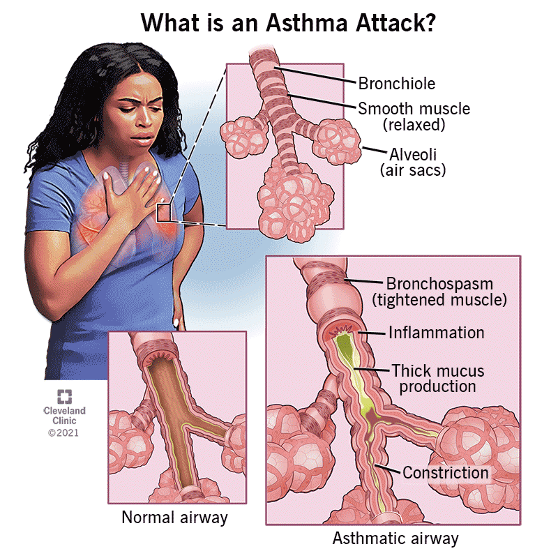 homeopathic medicine for asthma
